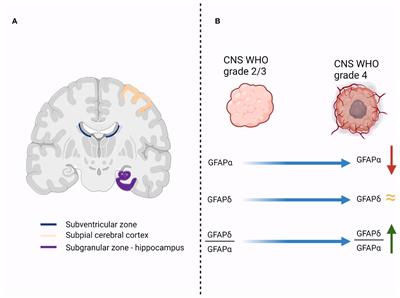 GFAPδ: A Promising Biomarker and Therapeutic Target in Glioblastoma